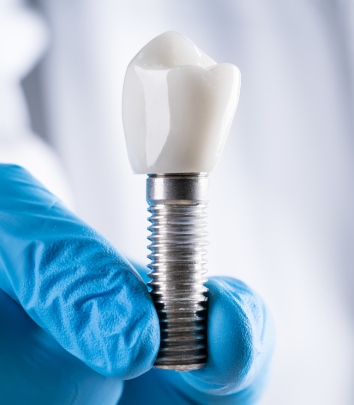 Dental Implants